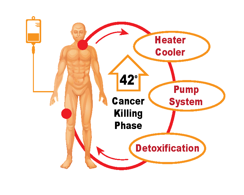 Heated Chemotherapy Treatment: How It Works 